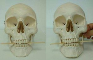 Na figura 1: o encaixe dos dentes da parte superior e inferior (plano oclusal) paralelo ao solo. Na figura 2: o encaixe dos dentes não é paralelo ao solo, por causa da assimetria